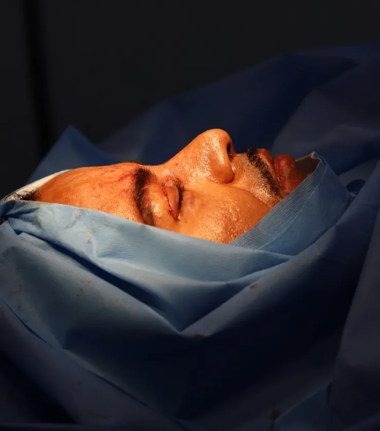 Blefaroplastia
