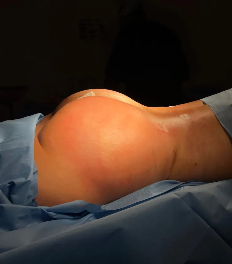 Gluteoplastia
