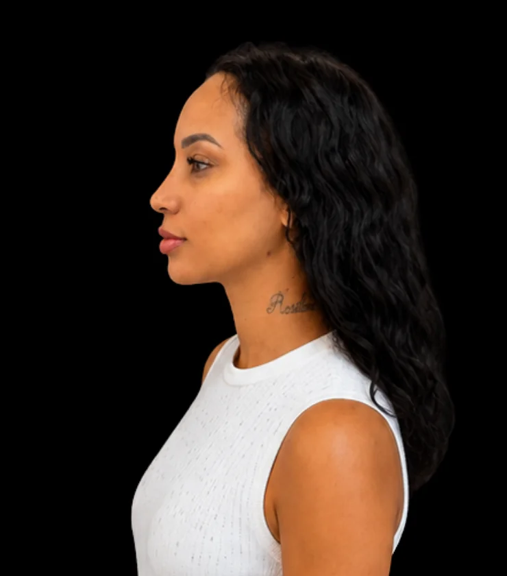 Rosto após harmonização facial