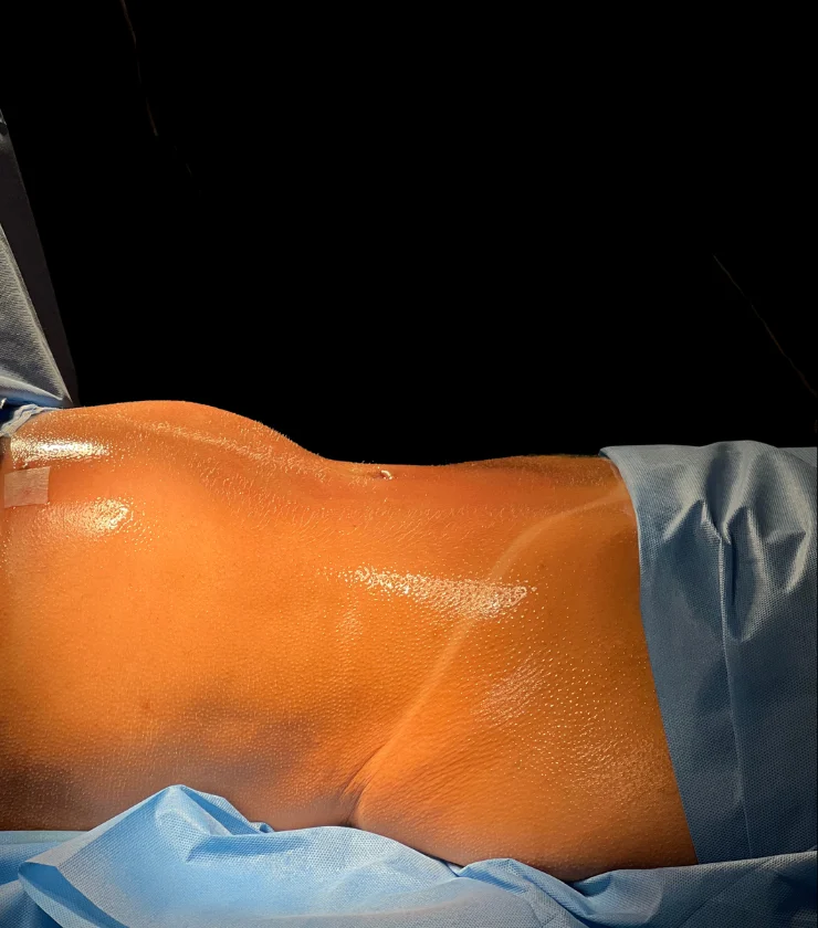 Hidrolipo