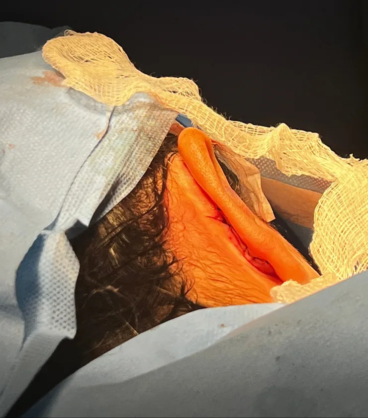 Otoplastia